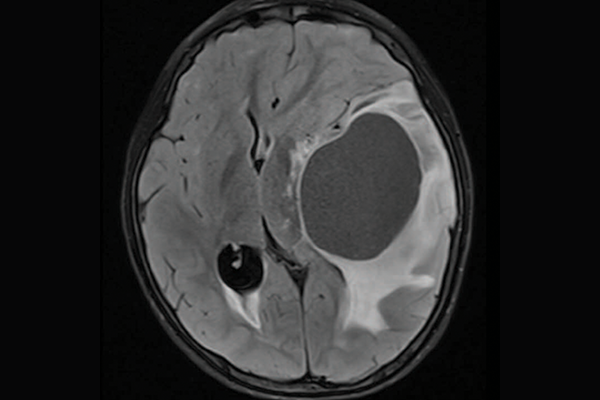 A scan of a brain with priMMRD subtype 3