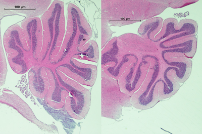 Two side by side stains of a brain tumour, the right showing reduced growth.