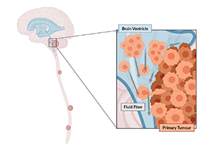 An illustration of a brain and spinal cord, with a box zooming in on the base of the brain showing a brain ventricle and primary tumour cells entering the fluid flow of the spinal cord.